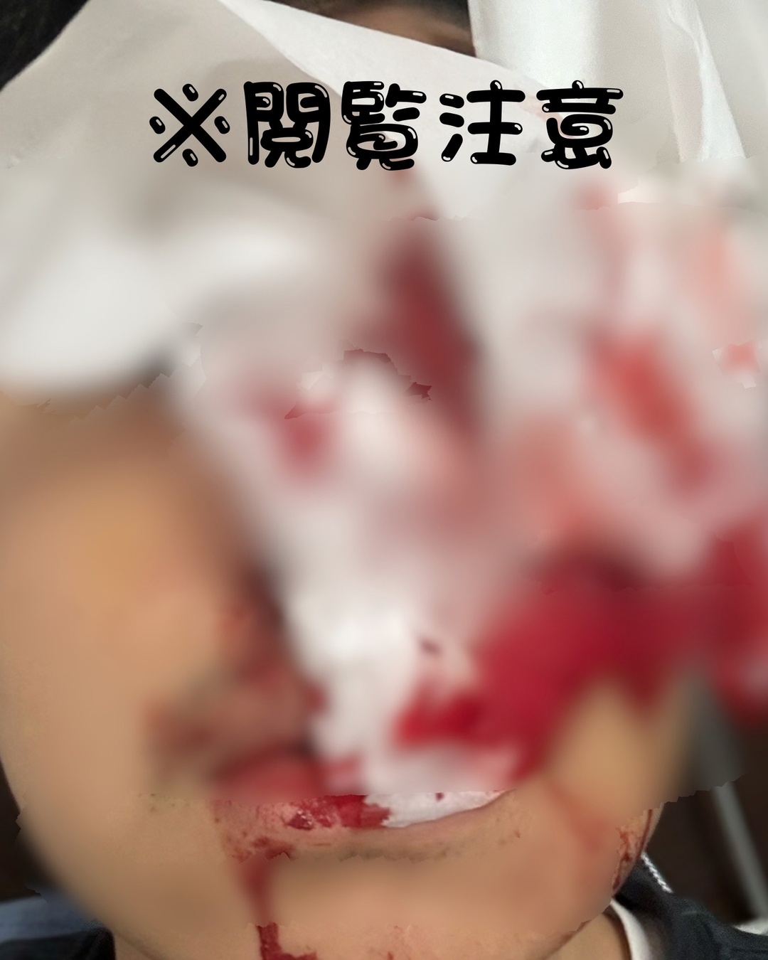 大量出血した当日の筆者（顔の一部と血液が写っている）